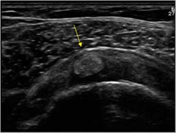Ultrasound image of Calcific tendinopathy of the Supraspinatus tendon (Rotator Cuff).